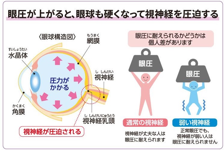 眼圧上昇が視神経に与える負荷の図