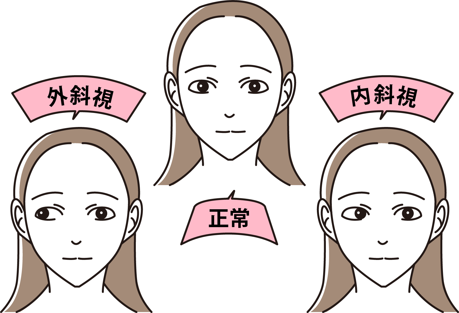 斜視